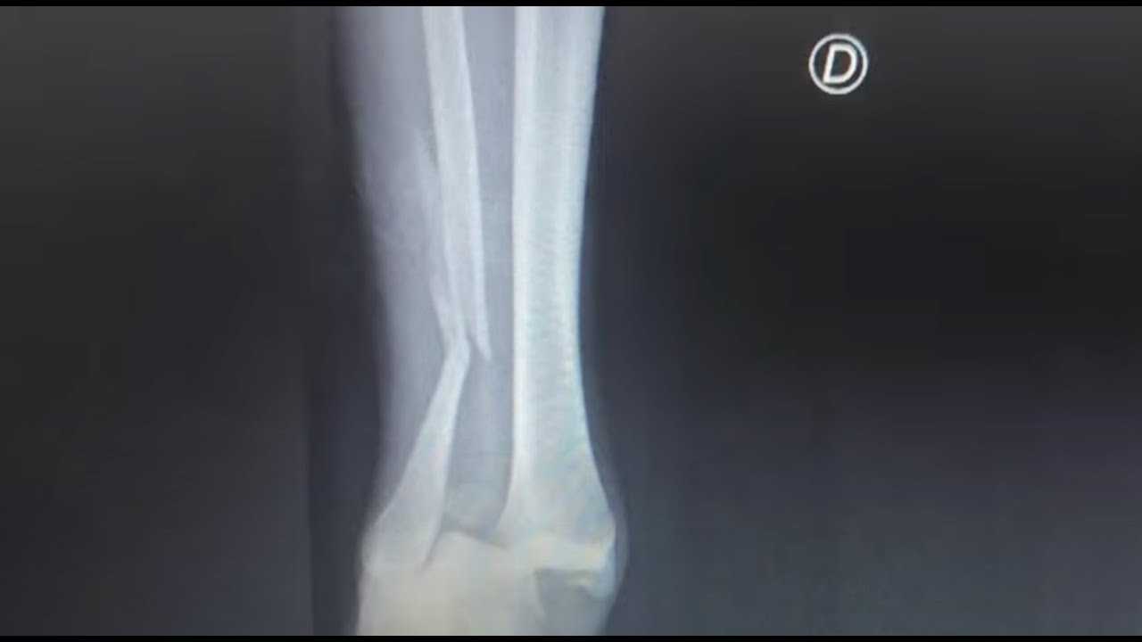 Gabriel is going through a difficult stage. A complicated injury kept him away from skateboarding, but fortunately he is almost 100% already. You can know all the details of the story through his testimony.<br /><br />Featured skaters: Gabriel Ribeiro, Gustavo Ribeiro, Bruno Serna<br /><br />Edit: Javier Menéndez<br /><br />Film: Javier Menéndez, Emidio Silva<br /><br />Skateboarding in MACBA<br />https://www.macbalife.com/shop<br />http://www.facebook.com/MacbaLife<br />http://www.instagram.com/MacbaLife