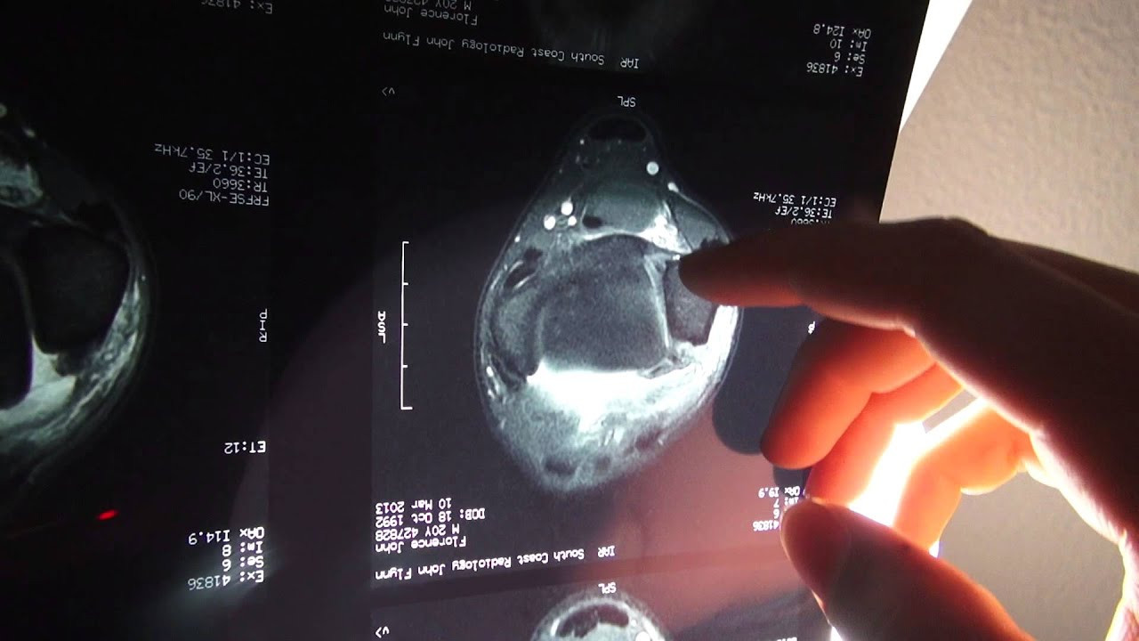 John John Florence walks us through the air that ended with a trip to the doctor and a sprained ankle. Good news is that it's not as bad as it could be and that listening to John John try to explain his x-ray is pretty entertaining. See more at http://www.hurley.com/johnjohnflorence.